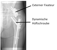 R&ouml;ngtenbild Bein